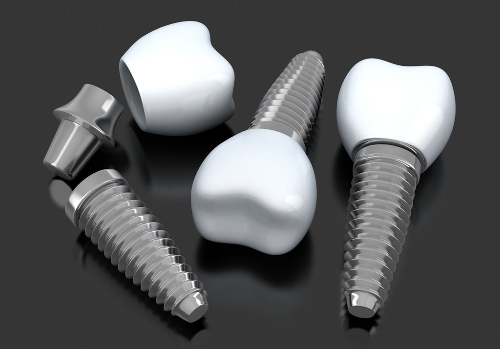 Implant-Implant-Dentaire-Alanya