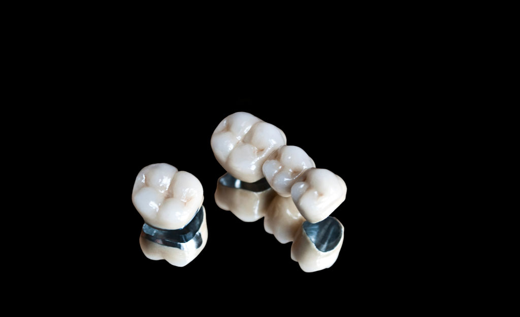 couronne-ceramo-metallique-IDA