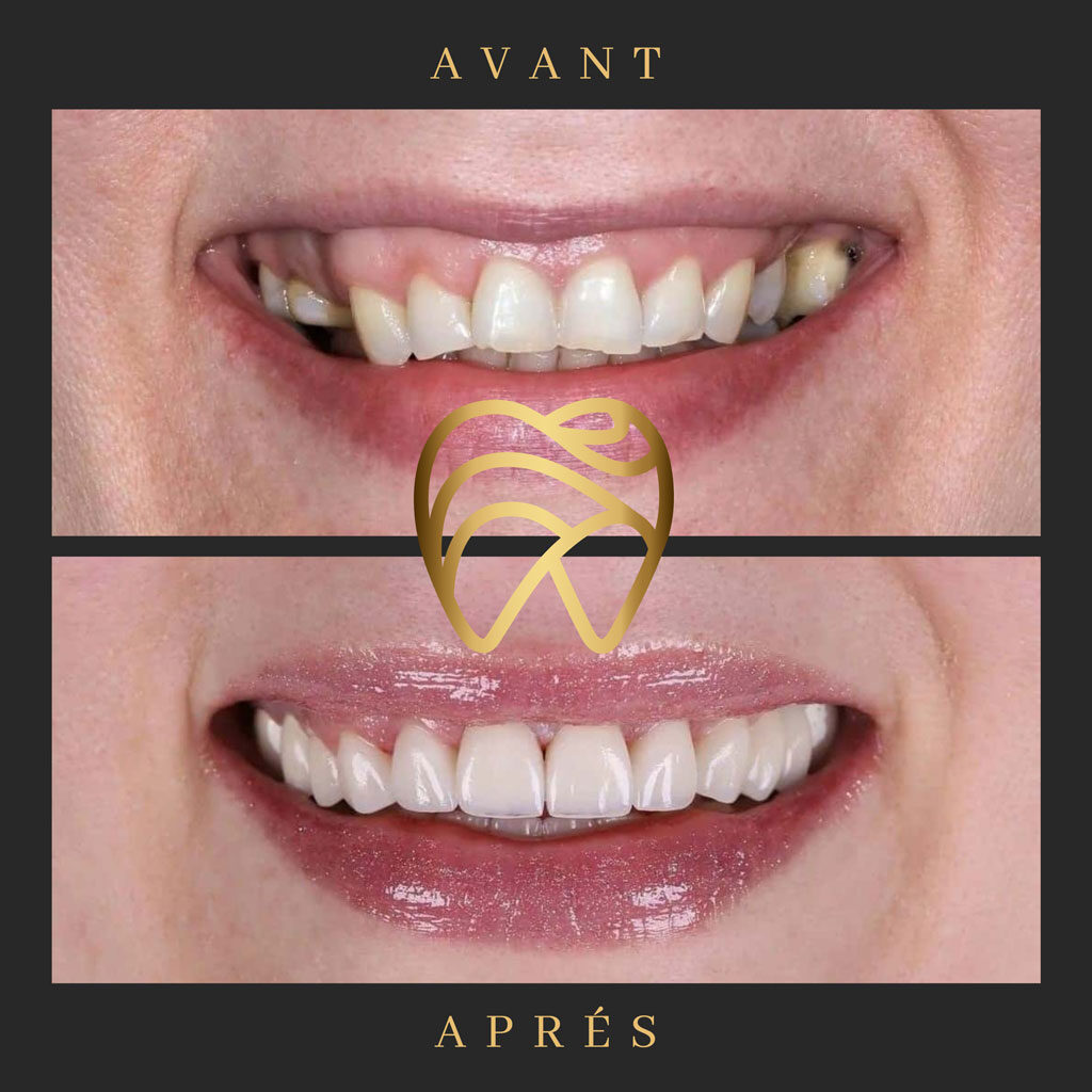 implantdentairealanya-13