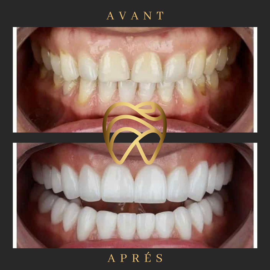 implantdentairealanya-3