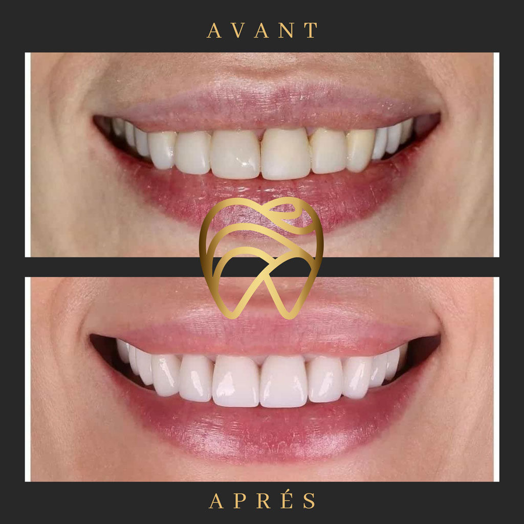 implantdentairealanya-4