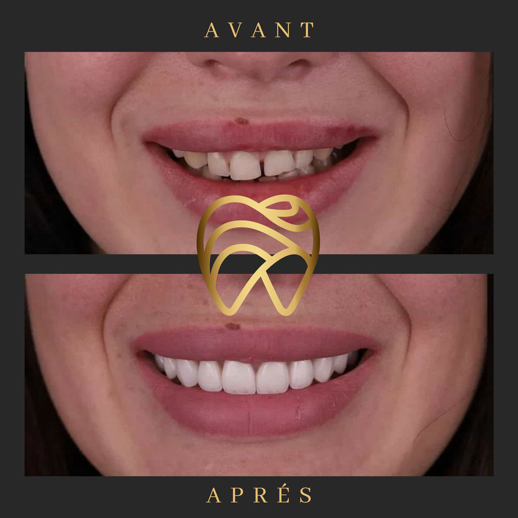 implantdentairealanya-8